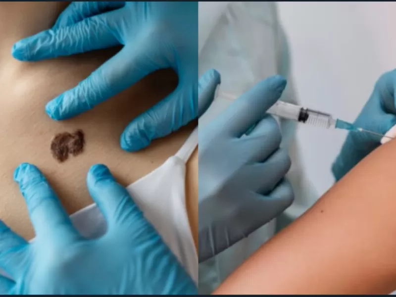 Cáncer de piel: ¿qué se sabe de este tratamiento desarrollado en Argentina?