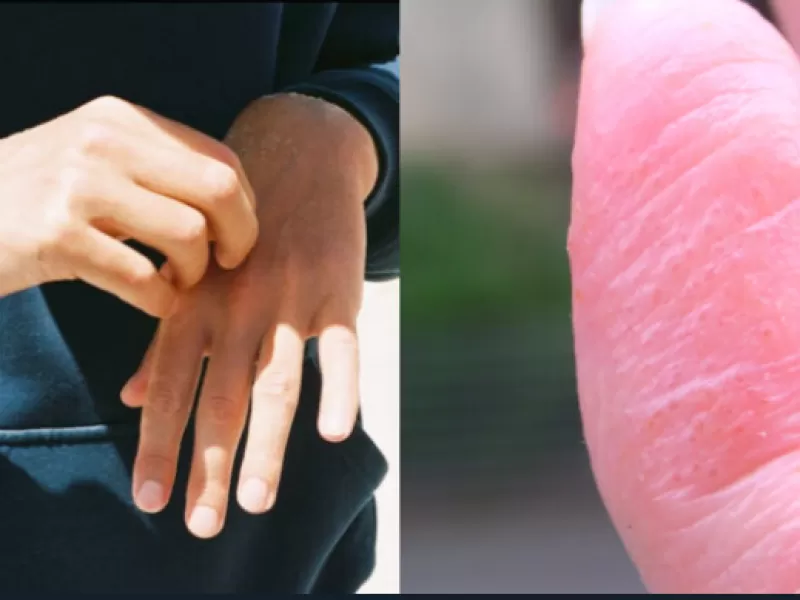Dishidrosis: ¿qué son los molestos granos que a muchas personas les salen en las manos y los dedos?